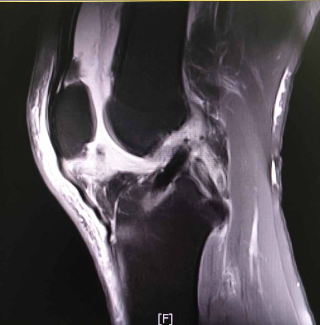 3-术后复查核磁jpg