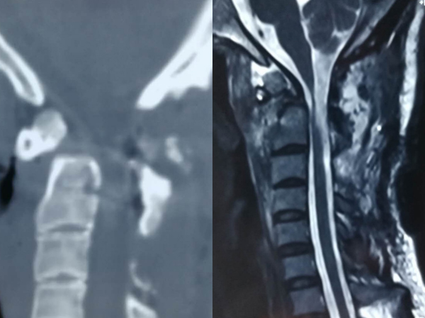 图4 术后CT及磁共振.jpg