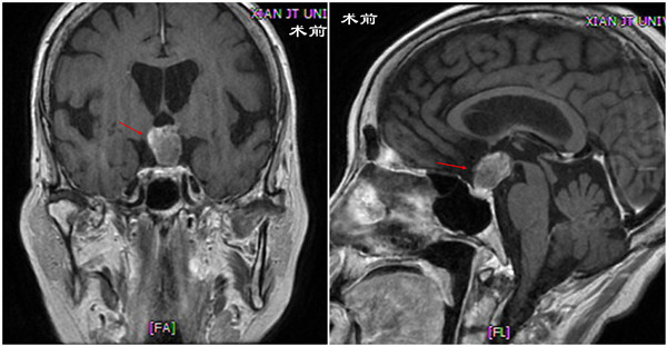 术前 冠状位_副本.jpg