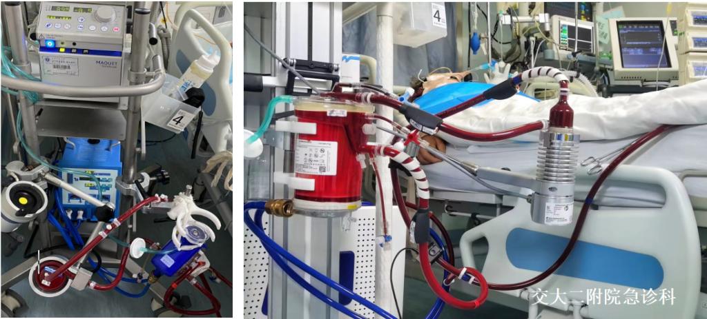 ECMO管路建立.PNG ECMO管路建立.PNG