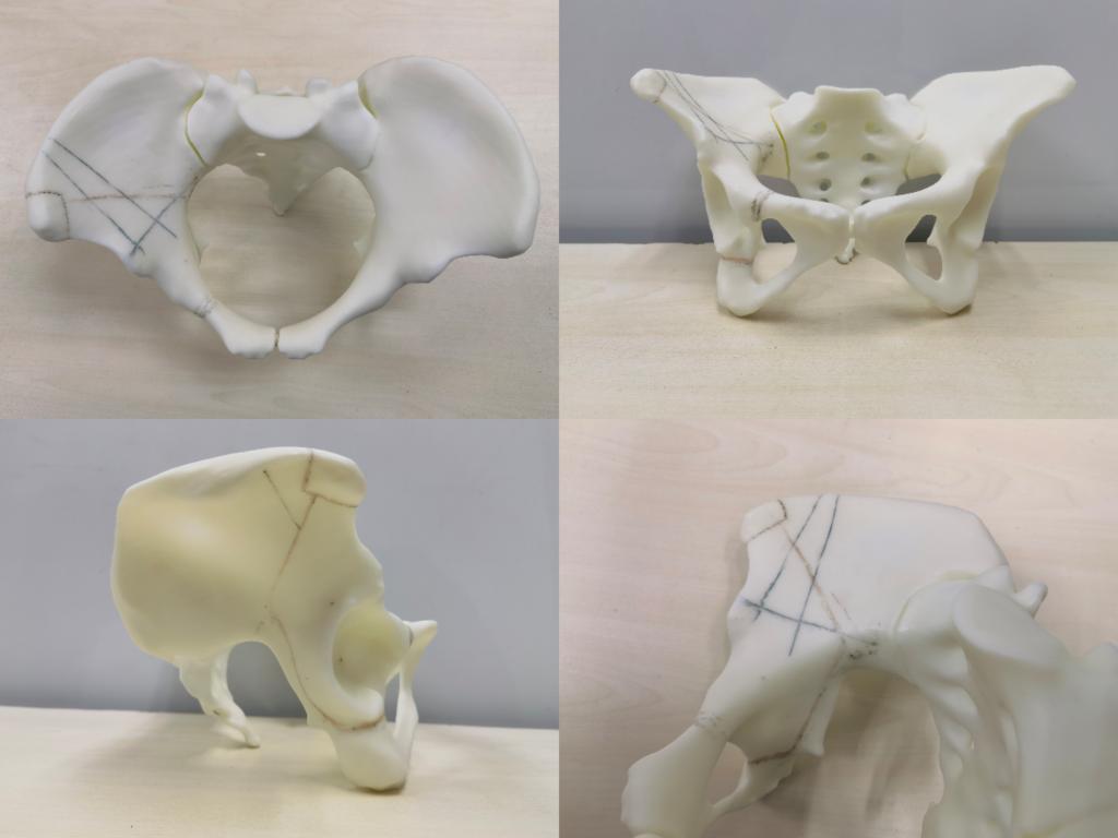 术前3D打印模型及截骨规划.jpg