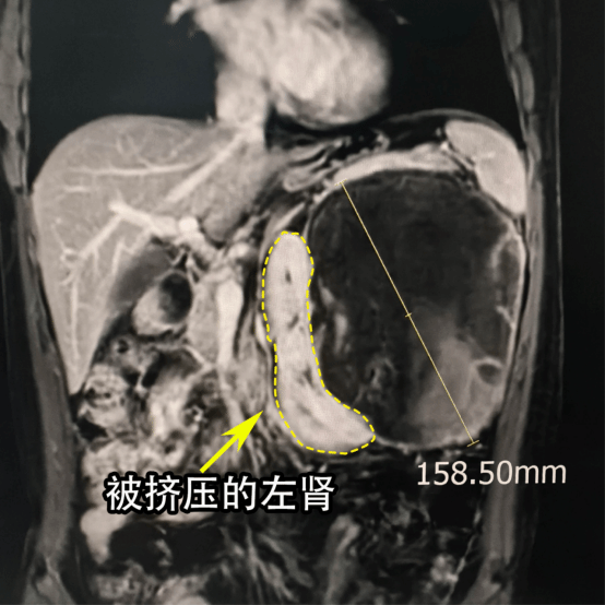图1 术前影像提示左肾被一巨大肿瘤推挤变形.png