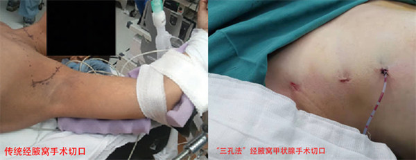 传统腋窝入路手术_副本.jpg