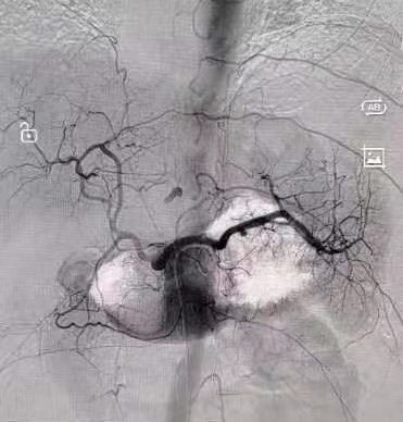 介入术前.jpg 介入术前.jpg