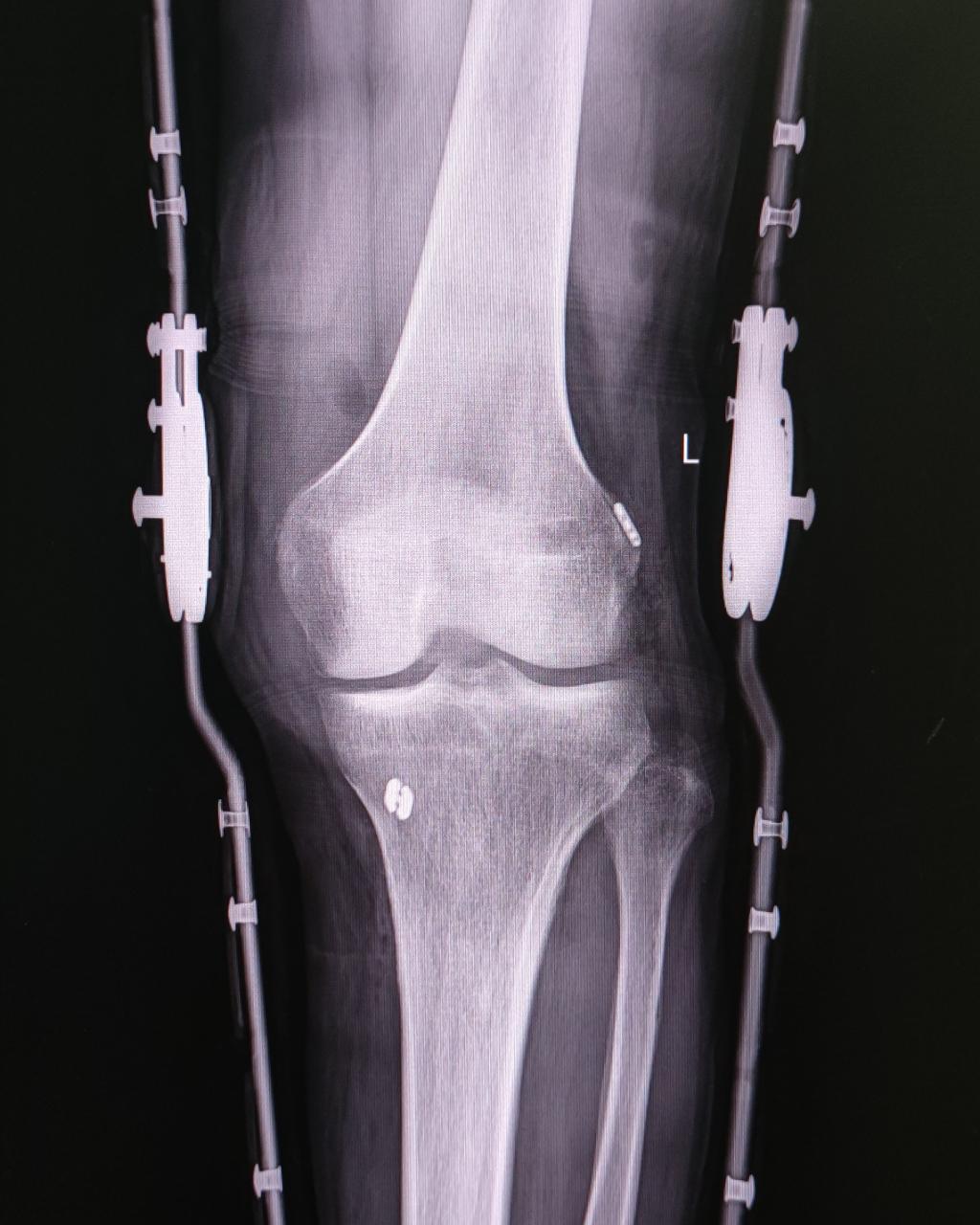 4-术后复查X线jpg