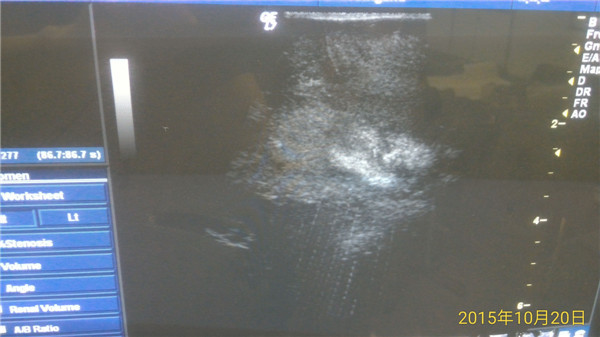 术中超声3.jpg