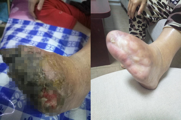 烂脚_副本.jpg 烂脚_副本.jpg