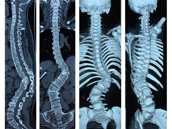 图2 术前全脊柱CT三维重建_副本.jpg