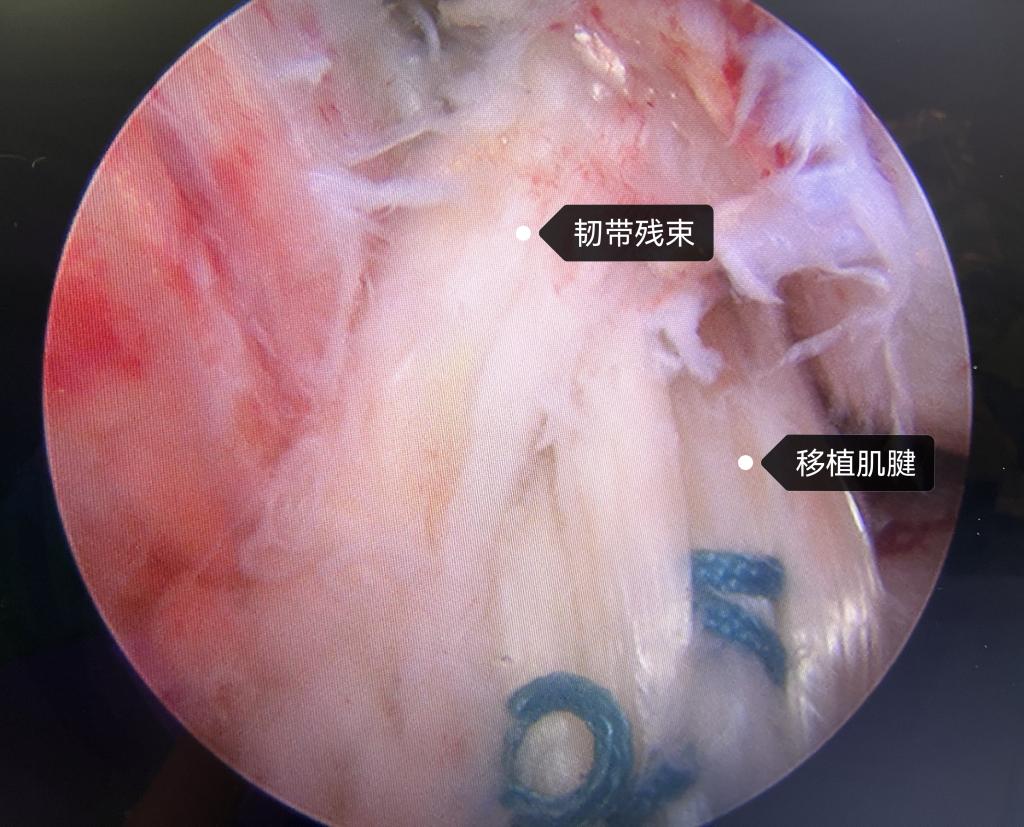 1-重建后术中照片jpg