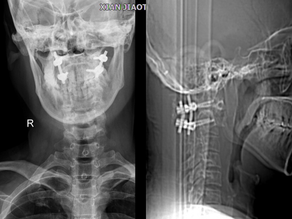图3 术后X线.jpg