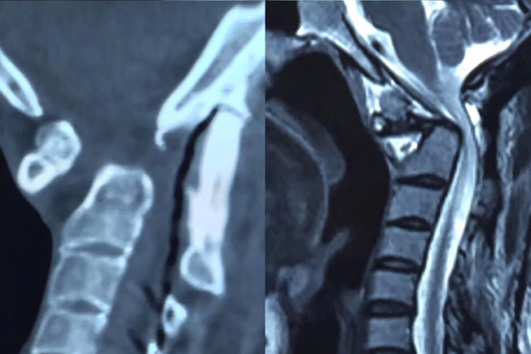 图2 术前CT及磁共振.jpg
