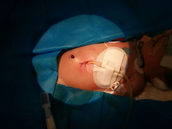 新生儿腹透置管术1.jpg